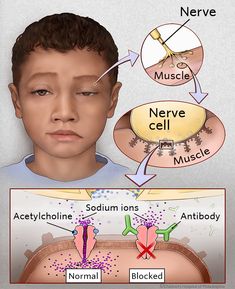 Kawasaki Illness Adalah Kawasaki Illness Adalah