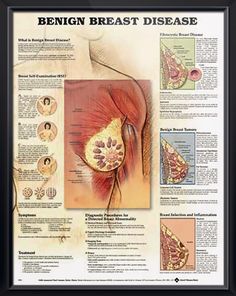 Natural Remedies For Benign Breast Cysts Natural Remedies For Benign Breast Cysts