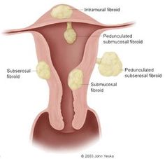 How To Treat Fibroid Pain Naturally How To Treat Fibroid Pain Naturally