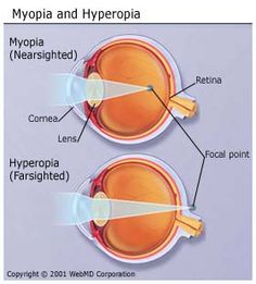 Magas fokú myopia és szülés - amit tudnod kell