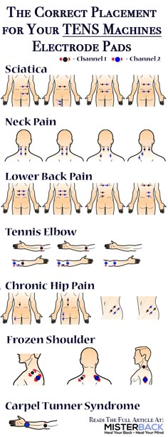9 TENS Unit Placement Diagram ideas | tens unit placement, ten unit