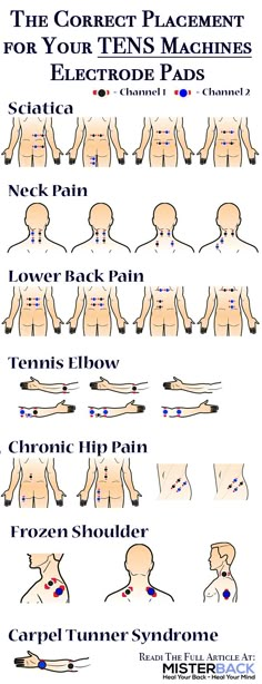 TENS is acknowledged and claimed to be a non-invasive and drug-free method for pain relief. How do I place my electrode pads to my tens unit or tens machine in a correct way? No matter if you have sciatica, neck pain, lower back pain, tennis elbow, chronic hip pain or something else, the placement is important, as shown in the image chart/list. No matter where your pain is, in this article, i also mention general body parts and when to replace the electrode pads for your tens machine. Chronic Pain, Hip Pain, Back Pain Relief, Sciatic Nerve, Neck Pain