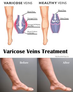varicose garden tratament darsonvalem recenzii