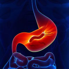 helicobacter pylori sintomas en el colon