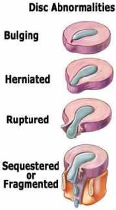 Natural Remedy For Bulging Disc In Back Natural Remedy For Bulging Disc In Back