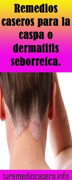 Dermatitis seborreica en cabello