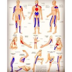 19 Ideas De Tendinitis Rotuliana Tendinitis Rotuliana Tendinitis Ejercicios