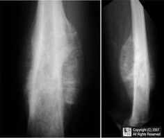 Tumor de ewing causas