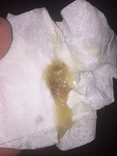 mucus plug does labor start when you lose it with photos labour when does mucus plug form