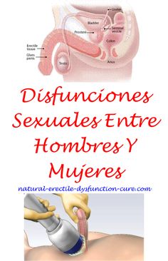 la cirugía de hernia inguinal puede causar problemas de erección