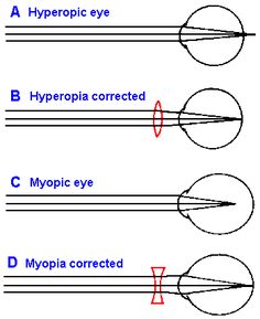 a hyperopia oka