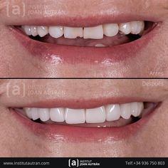 30 Mejores Imágenes De Diseño De Sonrisa En 2020 Diseños De Sonrisa Estetica Dental Carillas Dentales