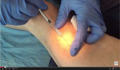 El venas de tratamiento para en mejor bangalore varicosas hospital