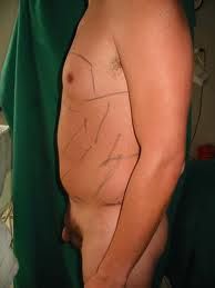 Depilacion laser axilas antes y despues de adelgazar