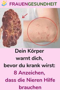 Noni, um Gewicht zu verlieren, wie man es nimmt