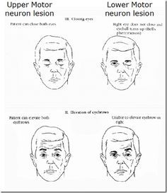 upper motor neuron