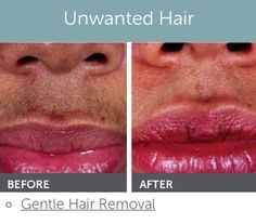 Those Facial rejuvenation wyoming Theme, Facial rejuvenation wyoming what