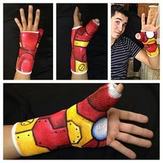 22 Ideas De Yeso Yeso Yeso En El Brazo Brazos