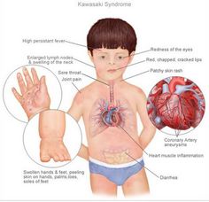 Rsv Treatment With Kawasaki Disease Rsv Treatment With Kawasaki Disease