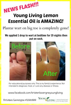 Best Shoes For Planter S Wart Best Shoes For Planter S Wart