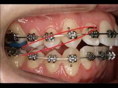 190 Ideas De Dientes Con Ortodoncia Ortodoncia Dientes Odontología