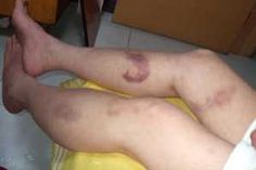 Como quitar hematomas rapidamente