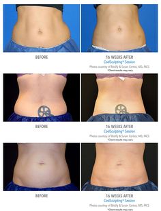 coolsculpting | vipszerver.hu