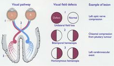 hemianopsia bitemporal