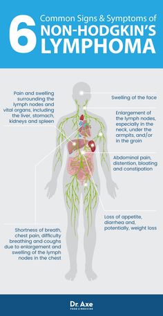 Natural Treatment For Non Hodgkin S Cancer Natural Treatment For Non Hodgkin S Cancer