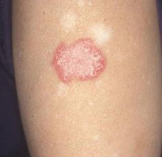 diskoid lupus erythematosus diskoid lupus erythematosus