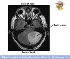 brain lesion locator than kinh pinterest brain brain lesions