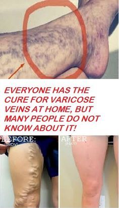 bai pentru tratarea varicelor varicoza pe picioarele conului solid