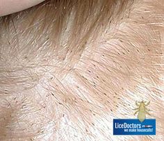 Incredible Spotting Lice In Blonde Hair Near Me