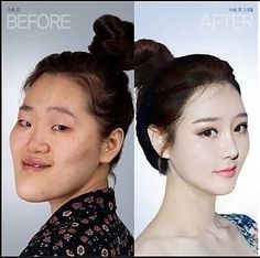 49 Best Plastic Surgery South Korea Images On Pinterest Belleza Before After Surgery In Korea South Korean Plastic
