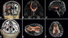 agenesia del corpo calloso imaging services agenesia del corpo calloso imaging services