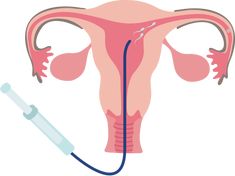 9 Ideas De Inseminación Artificial Inseminación Inseminacion Artificial Embarazo Multiple