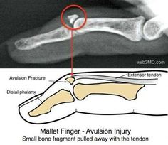 using a tuning fork for fractures using a tuning fork for fractures