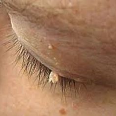 rid of skin tags on eyelids rid of skin tags on eyelids