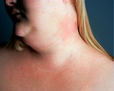 Dating bariatrische chirurgie