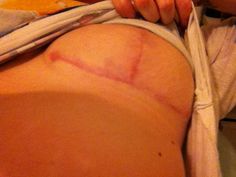 post op breast surgery Self absorbed ass video