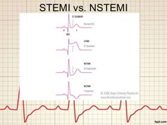 Best treatment options for stemi and nstemi