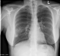 lobar pneumonia also known as a non segmental pneumonia or focal