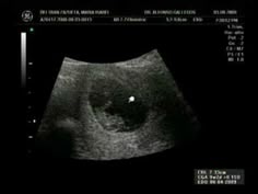 21 Ideas De Salud Ecografias Embarazo Imágenes De Ultrasonido Ultrasonido