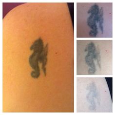 pin by sarah home on laser tattoo removal from the missing ink pin by sarah home on laser tattoo removal from the missing ink
