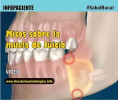 cuidados despues de quitarse solfa syllable muela del juicio