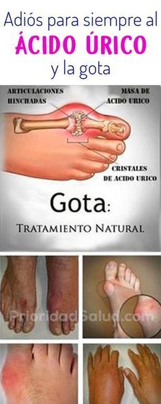 Acido urico dieta recomendada al dia