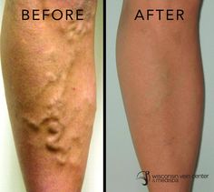 wisconsin vein center u0026 medispa offers laser tattoo removal using wisconsin vein center u0026 medispa offers laser tattoo removal using