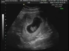 21 Ideas De Salud Ecografias Embarazo Imágenes De Ultrasonido Ultrasonido