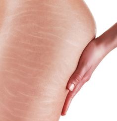 肉割れ のアイデア 8 件 21 ダーマペン 肉 割れ 肉割れ のアイデア 8 件 21 ダーマペン 肉 割れ