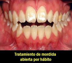 Mordida abierta antes y despues de adelgazar Mordida abierta antes y despues de adelgazar